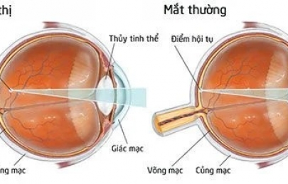 CẬN THỊ NGUYÊN NHÂN VÀ CÁCH ĐIỀU TRỊ